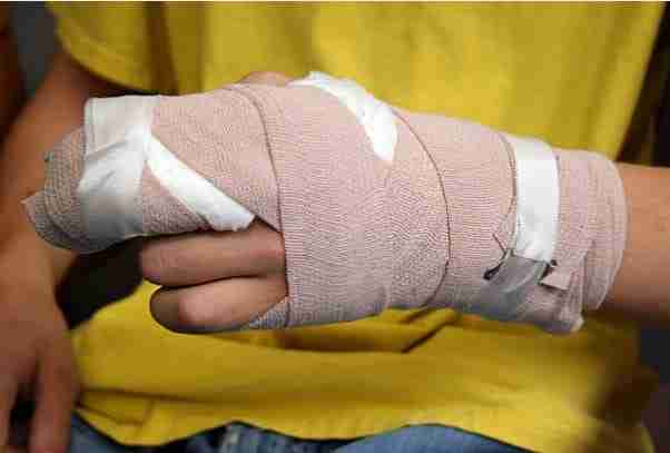 Burn Injuries: Causes, Types, and Prevention